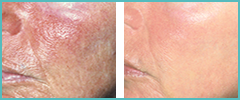 BDR - poboljšana tekstura kože improved skin texture